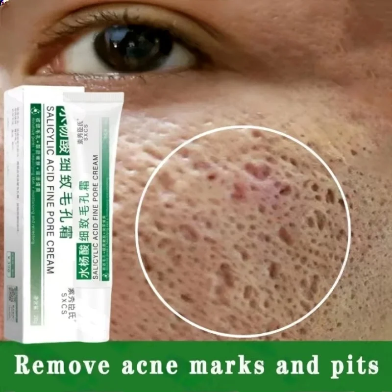 Krem z kwasem salicylowym do o – Azelaic Acid Cream recenzja i cena