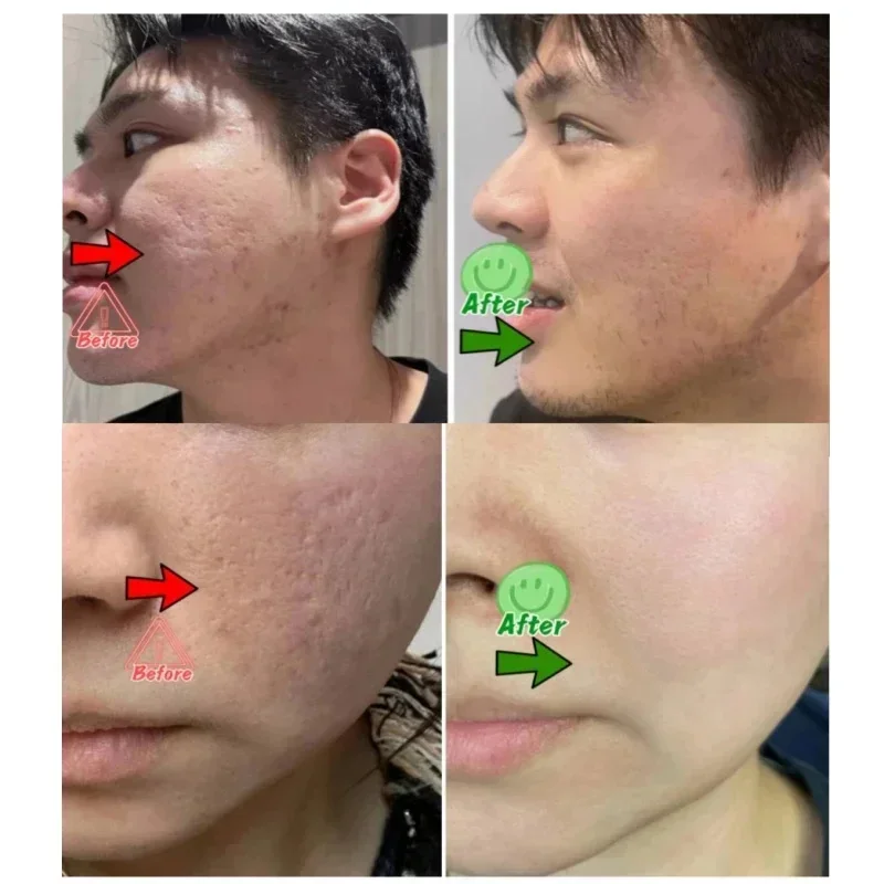 Krem z kwasem salicylowym do o – Azelaic Acid Cream recenzja i cena