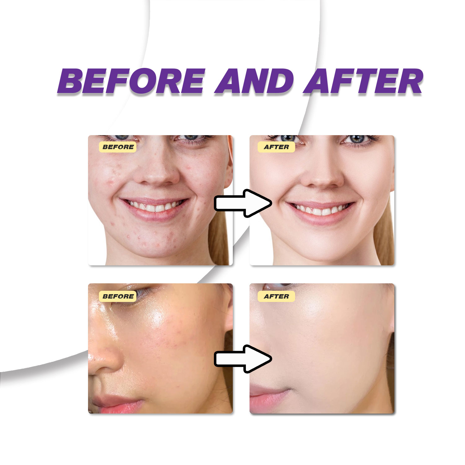 Łagodny krem z kwasem azelaino – Azelaic Acid Cream recenzja i cena