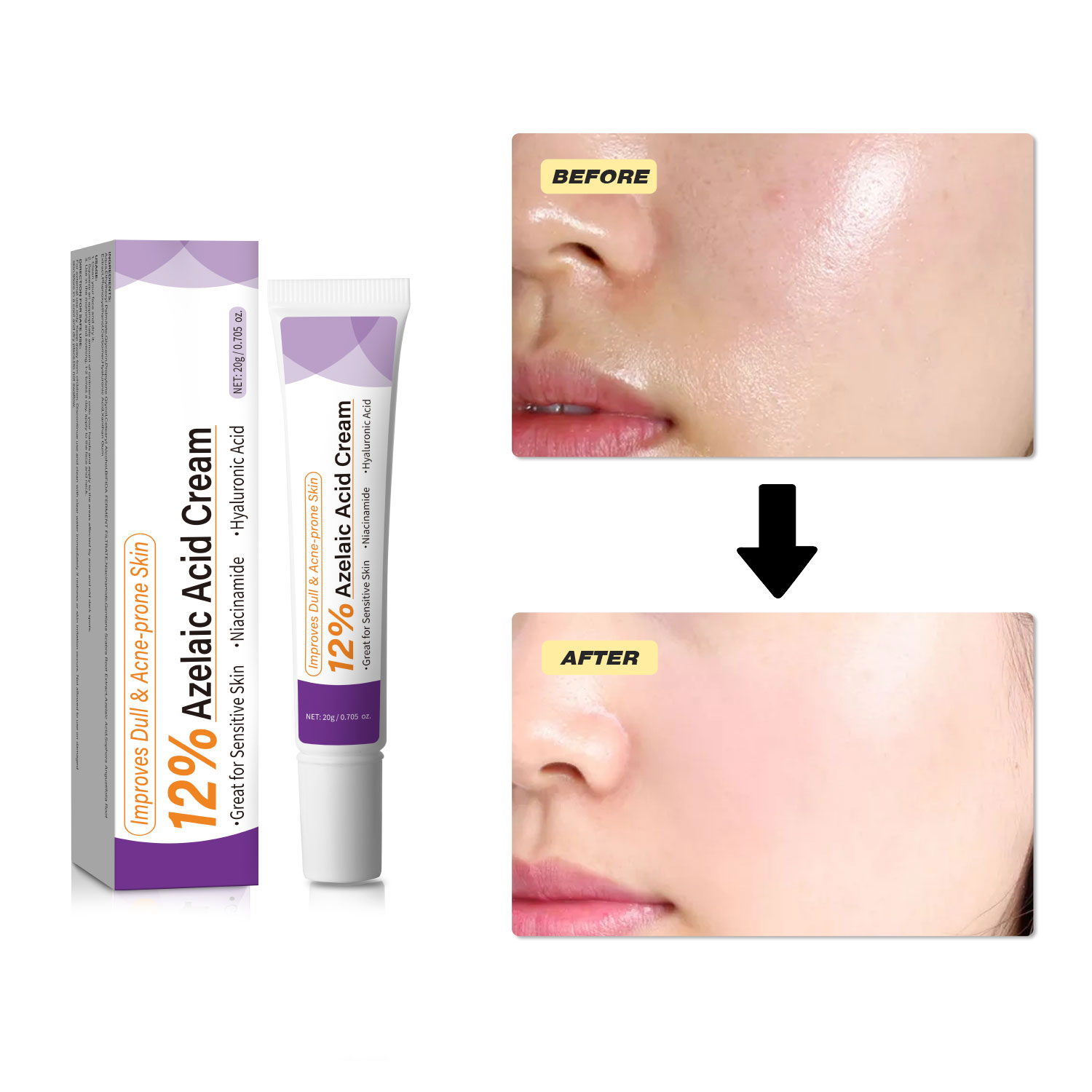 Łagodny krem z kwasem azelaino – Azelaic Acid Cream recenzja i cena